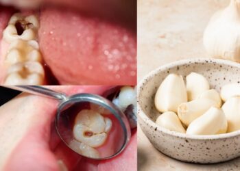 Garlic can remove the cavity and rot of teeth, know when and how to use?