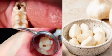 Garlic can remove the cavity and rot of teeth, know when and how to use?