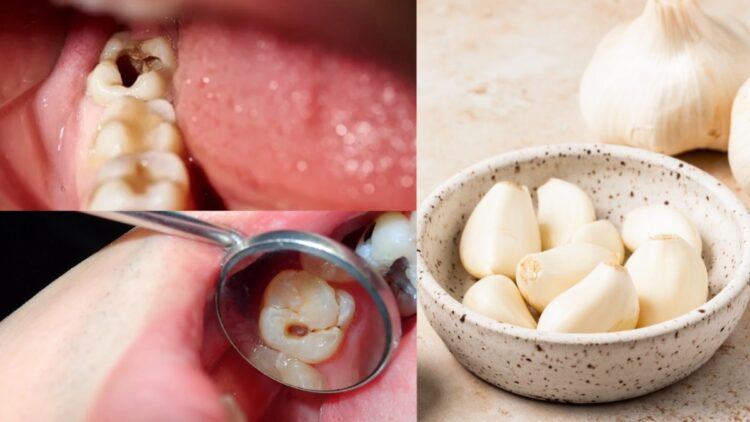 Garlic can remove the cavity and rot of teeth, know when and how to use?