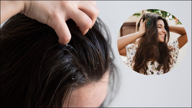 Head itching, dandruff and hair loss are troubled, know due to this