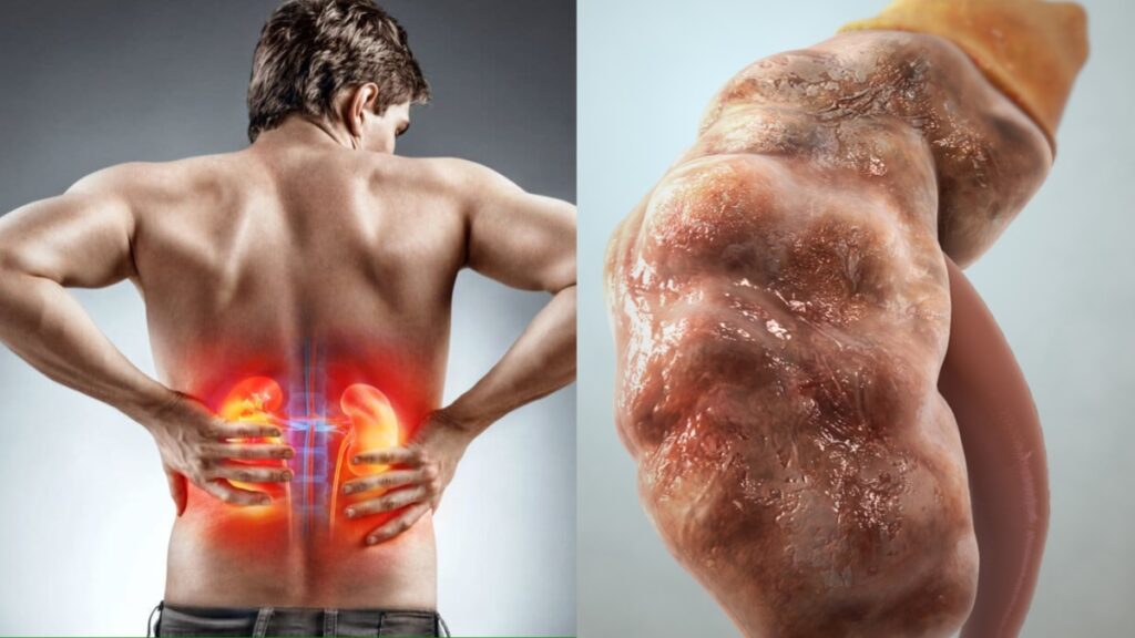 In the beginning, these symptoms start appearing in the beginning of kidney problems, do not forget or not.
