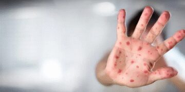 Measles outbreak in Israel, 48 cases came to the fore, vaccination started