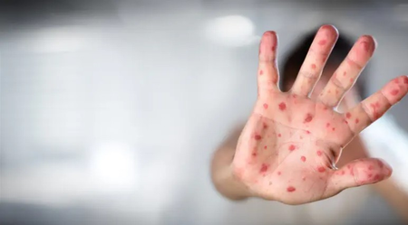 Measles outbreak in Israel, 48 cases came to the fore, vaccination started