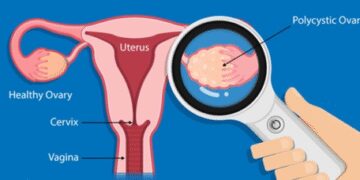 PCOS also puts an impact on women's brain: study
