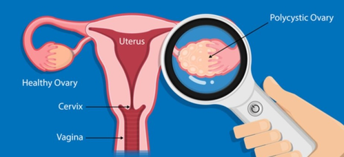 PCOS also puts an impact on women's brain: study