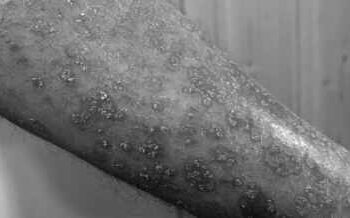 Skin cancer cases are increasing rapidly in older men in the last 30 years: Study