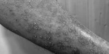 Skin cancer cases are increasing rapidly in older men in the last 30 years: Study