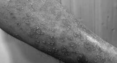 Skin cancer cases are increasing rapidly in older men in the last 30 years: Study