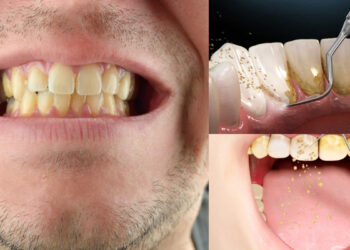 These things will remove frozen cavity and yellowness on the teeth