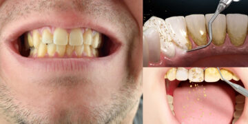 These things will remove frozen cavity and yellowness on the teeth
