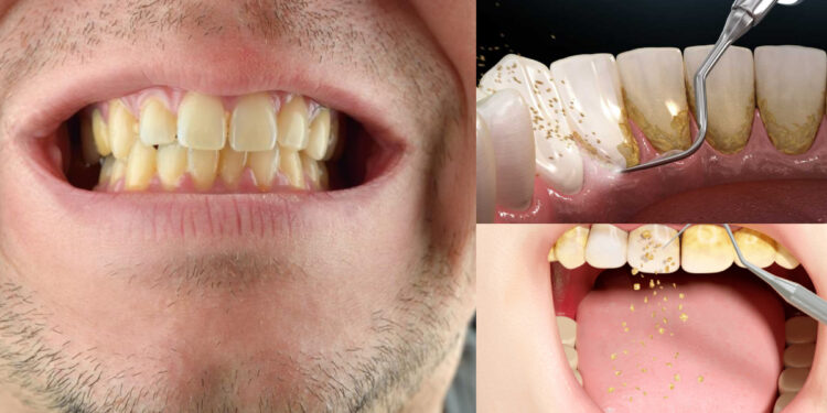 These things will remove frozen cavity and yellowness on the teeth