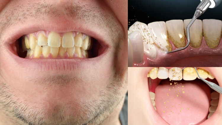 These things will remove frozen cavity and yellowness on the teeth