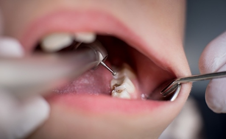 Toothache and pain attack! Get rid of this way