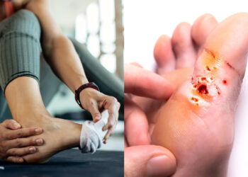 What is diabetic foot, diabetes patients can have these problems in the feet