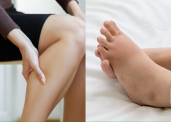 What is water retention due to which swelling starts in the body, know which can be done