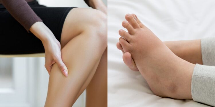 What is water retention due to which swelling starts in the body, know which can be done