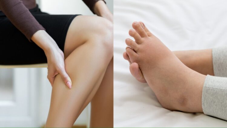 What is water retention due to which swelling starts in the body, know which can be done