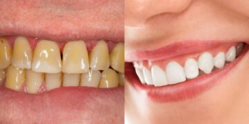 Yellow teeth will shine with salt and mustard oil, stubborn plaque will also be discharged, know how