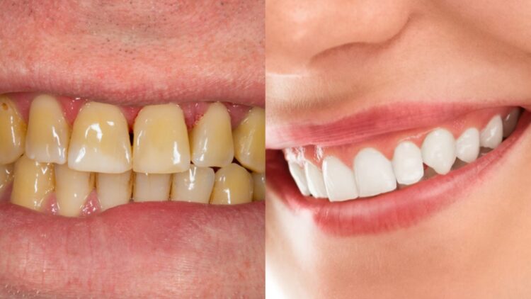 Yellow teeth will shine with salt and mustard oil, stubborn plaque will also be discharged, know how