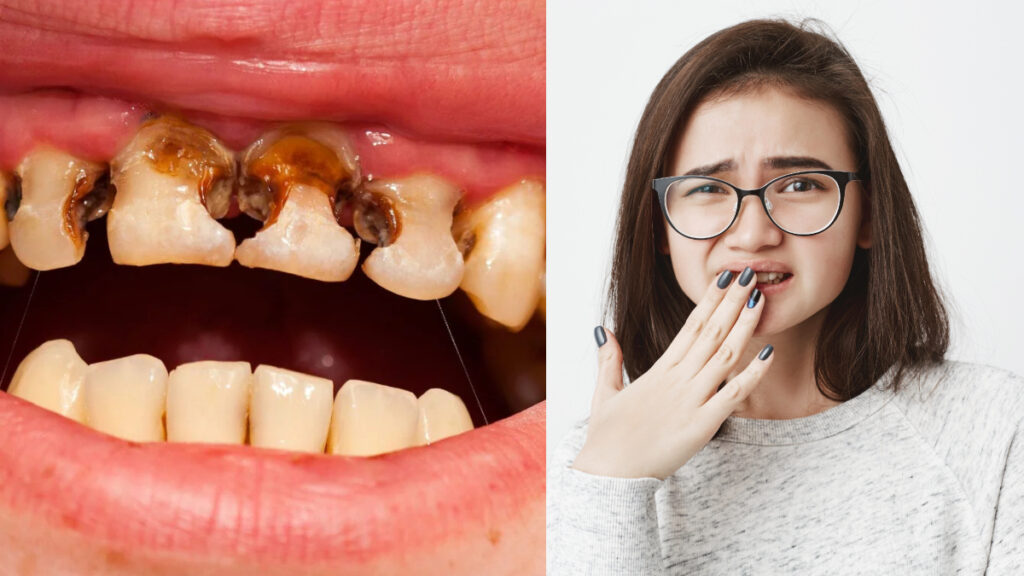 Your teeth can rot by not cares in summer, definitely follow these tips
