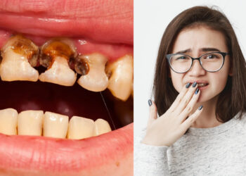 Your teeth can rot by not cares in summer, definitely follow these tips