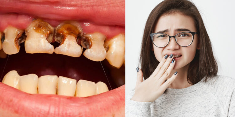 Your teeth can rot by not cares in summer, definitely follow these tips
