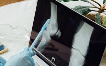 Large achievement of Indian scientists, new tool will detect early bone cancer