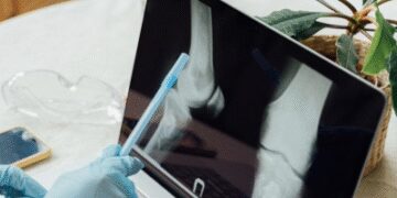Large achievement of Indian scientists, new tool will detect early bone cancer