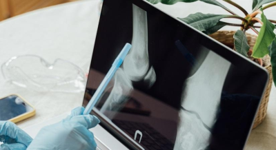 Large achievement of Indian scientists, new tool will detect early bone cancer