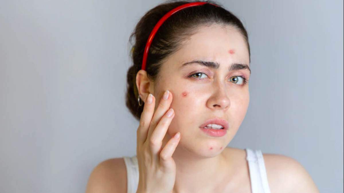सावधान! चेहरे के पिंपल्स से पीछा छुड़ाने के चक्कर में कर बैठते हैं ये 3 आम गलतियां, और भी बिगड़ सकता है चेहरा 