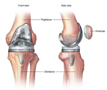 Diabetic pesters' risk of infection after knee surgery: Study