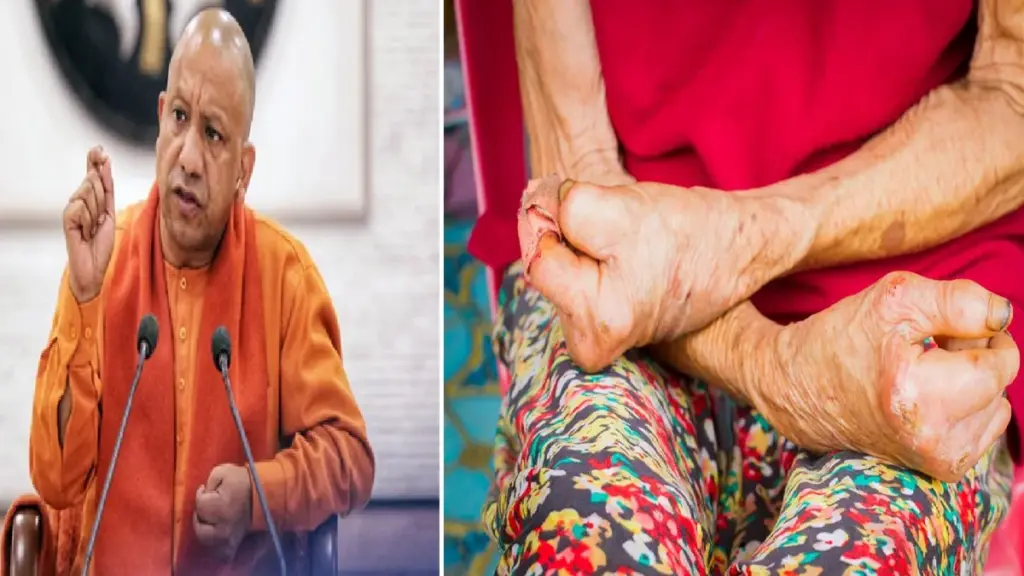 Yogi Adityanath Government: Yogi Sarkar, who is a support for leprosy patients and disabled, the needy financial assistance is being received with transparency, Yogi Government Became a Support for Leprosy Patients and Disabled People, Financial Help IS PROVIDED on Time with transparency