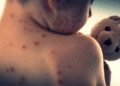 481 new cases of measles came out in Israel, total number 1,251