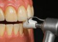 Are you disturbed by yellow teeth? Return pearls in these ways