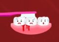Bleeding from gums is not just oral problem, it is also a gesture towards internal problems of the body