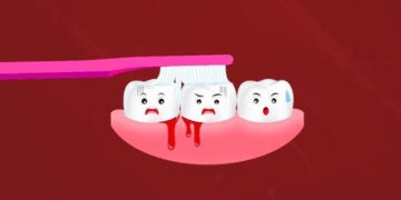 Bleeding from gums is not just oral problem, it is also a gesture towards internal problems of the body