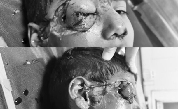 Crazy dog ​​terror in Suratpura: Various attack on six -year -old innocent, where are you responsible?