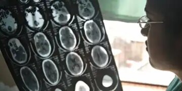 1 out of every 3 people in the world suffers from brain disorder, 11 million people die every year: Report