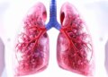 Chest X-ray is insufficient to detect whether TB patient's relatives are infected or not: The Lancet