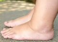 Do feet swell after standing or sitting for a long time? Adopt these natural methods, you will get instant relief