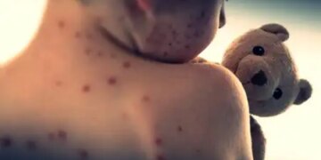 Increased measles cases in Canada, premature child died in Alberta