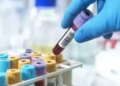 New blood test-based model enabled to predict the risk of severe liver disease