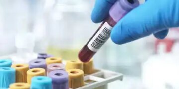 New blood test-based model enabled to predict the risk of severe liver disease
