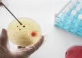 TB patients can get better treatment from steroids, big revelation in the study