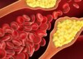 Your small habits can increase cholesterol, learn how to control it from Ayurveda