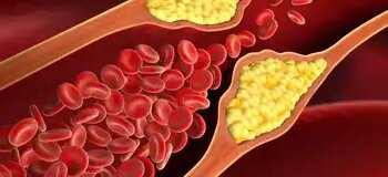 Your small habits can increase cholesterol, learn how to control it from Ayurveda