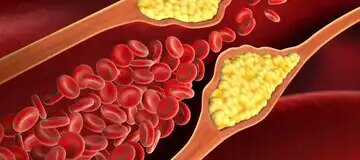 Your small habits can increase cholesterol, learn how to control it from Ayurveda