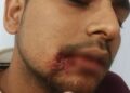 Attempt to snatch a bag full of jewelery from a bullion trader, grocery trader injured due to bullet injury