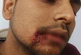 Attempt to snatch a bag full of jewelery from a bullion trader, grocery trader injured due to bullet injury