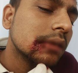 Attempt to snatch a bag full of jewelery from a bullion trader, grocery trader injured due to bullet injury